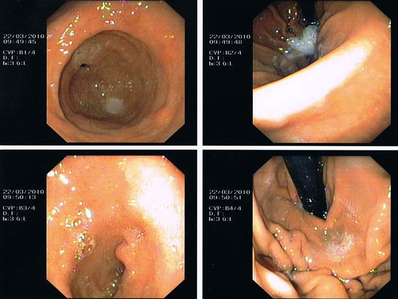 Stomach Polyp